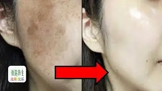 Eliminate age spots! This will eliminate age spots forever! The method is super simple!