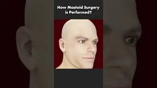 How Mastoid Surgery Is Performed? (Mastoidectomy)