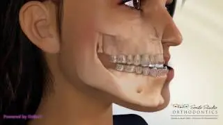 BSSO Mandibular Setback - Bracket With Face