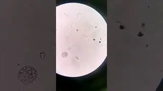 White blood cells vs Red blood cells in urine 