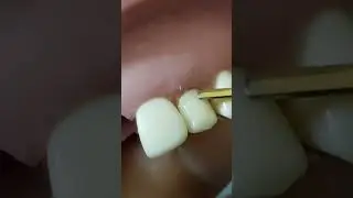 direct composite veneer / part 1 #dr_ghazal #veneers #preparation #teeth