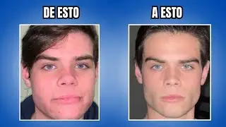 Transforma Tu Rostro: Cómo Cambiar la Estructura Ósea Facial - Guía Completa