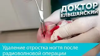Удаление отростка ногтя после радиоволновой операции вросший ноготь