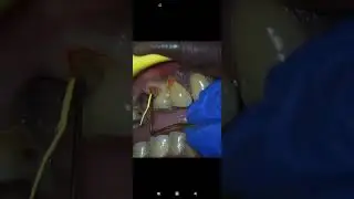 How to Pack Teflon for Gingival Retraction