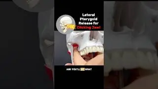 Clicking popping Jaw? Try this Lateral Pterygoid Release! 