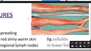 Cellulitis