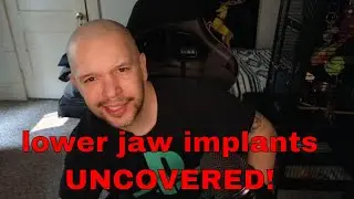 My dentist uncovered my lower jaw implants