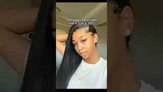 #Lupus Hair Loss #NationalHairLossAwarenessMonth