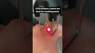 These Lasers Are PERFECT For Enlarged Pores 🤩