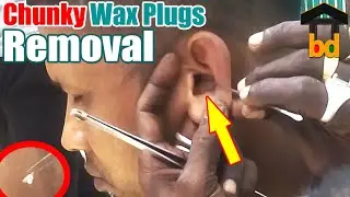 ►Dirt Removal with White Wax II Relaxing Ear Cleaning at Roadside II Satisfactory Ear Waxing BD