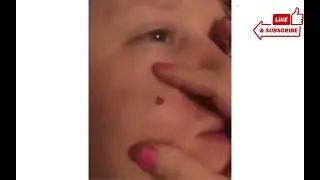 TOP 50 PIMPLE REMOVAL AND BLACKHEAD REMOVAL😱😱 2022  || PIMPLE POPING || Busty Poper