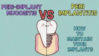 Peri Implant Mucositis vs Peri-Implantitis | HOW TO MAINTAIN YOUR DENTAL IMPLANTS