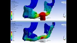 High Load Impact Simulation on the Implant of a Mandibular Fracture - ANSYS WB Explicit Dynamics