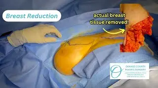 Breast Reduction Surgery | Orange County Plastic Surgery