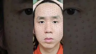 คนไทยมีสิว 250 เม็ด 