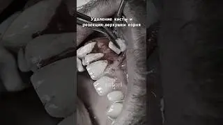 Cyst of the tooth apex 