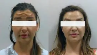 Botoks terapija pred in potem | Estetika Nobilis