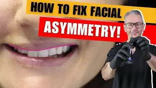 How to fix facial asymmetry with Botox.