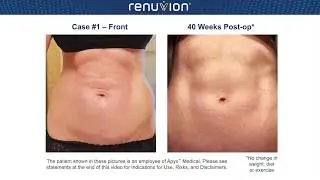 Renuvion Abdominal Case
