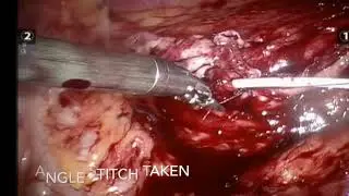 ECTOPIC KIDNEY ROBOTIC PYELOPLASTY USI