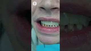 Удалили 15 разрушенных зубов и установили временные конструкции. Имплантация зубов.