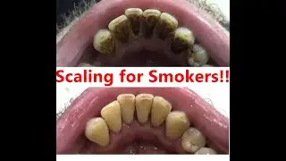 After Scaling and Polishing!!!!! Teeth cleaning for smokers!