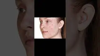Cara Menghilangkan Jerawat || Photoshop Tutorial Indonesia
