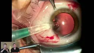ICL Surgical Footage and Discussion
