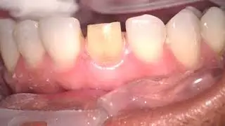 Prep Discolored Tooth #8(11)for Crown