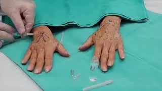 Hands rejuvenation with HYAcorp MLF1