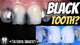 Restoring An Endodontically Treated Teeth.. 