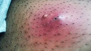 India's Best Cyst Busting!  Surgery, Infections & Popping!