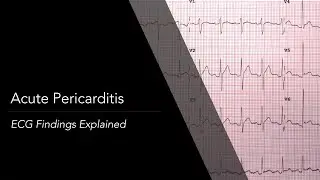 Acute Pericarditis ECG