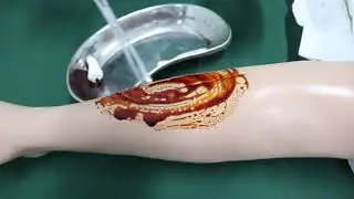 PEMBERIAN ANASTESI LOKAL LIDOCAINE