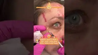 Nobody wants Crows Feet, keep them Away with These Injections!