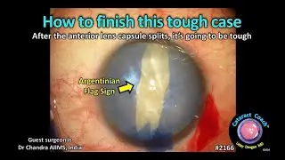 CataractCoach™ 2166: argentinian flag sign just happened - how to finish this tough case