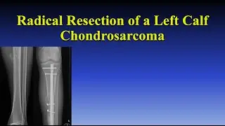 Radical Resection of a Left Calf Chondrosarcoma