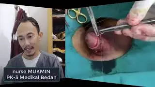 Circumcision or circumcision is an old method, but it is still an existed until now