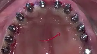 RESULTADO PERFECTO, AJUSTES ESPECTACULARES Y CEMENTADO DEFINITIVO EN 24 H CON IMPLANTES BICORTICALES