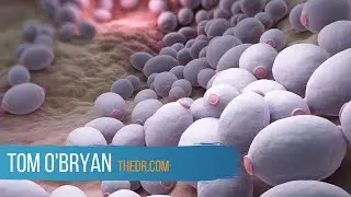 Dr. Tom and Christa Orecchio Discuss Candida - Dr. Tom O'Bryan