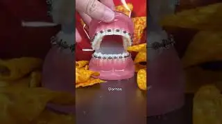 Chips to avoid with braces 