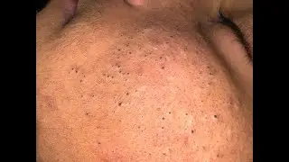 Blackhead Extraction Remove Ultimate Blackheads & Pimples – Deep Cleanser