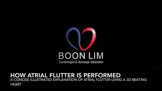 Atrial Flutter Ablation : A concise illustrated video explaining how atrial flutter is performed.