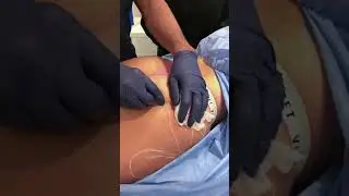 Buttocks Enhancement using Sculptra Injections & PRP - Special Pump Method | Dr. Khorasani | NYC