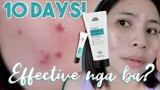 10 DAYS with LUXE ORGANIX AHA BHA CLEANSER and PIMPLE CORRECTOR
