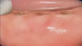 Имплантация зубов