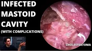 Infected Mastoid Cavity With Cholesteatoma (Condylectomy May Be Needed)
