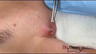 Drainage of an inflamed epidermal cyst just above the bridge of the nose and subsequent removal