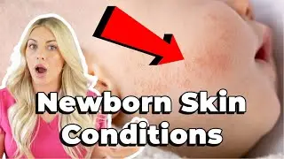 Common Baby Skin Conditions and How to Treat Them