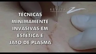 Técnicas Minimamente Invasivas e Jato de Plasma